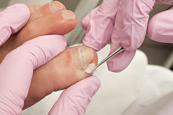 ingrown toenail