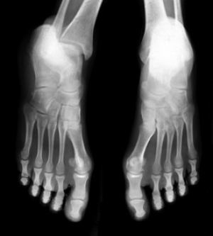 Possible Causes of Stress Fractures