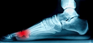 Types of Sesamoid Injuries