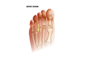 Signs of Morton&#039;s Neuroma