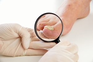 Common Factors That Influence Developing Toenail Fungus