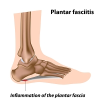 Possible Methods to Find Relief From Plantar Fasciitis