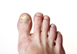 Toenail Fungus or Tinea Unguium