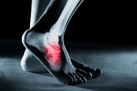 A Common Reason for Stress Fractures