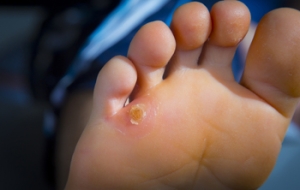 Types and Causes of Corns on the Feet