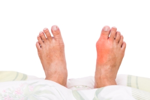 What Is a Tailor’s Bunion?