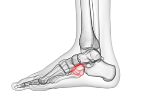 Treatment of Cuboid Syndrome