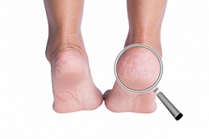 Wearing Backless Shoes May Lead to Cracked Heels
