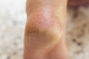 Cracked Heels and Diabetes