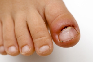 Signs and Causes of Toe Infections