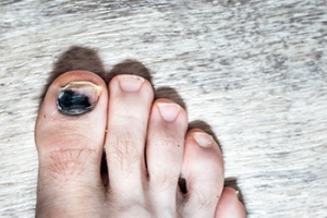 Definition and Causes of Black Toenails