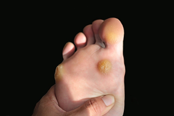 Ways to get rid of corns on feet outlet