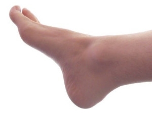 A Stress Fracture Can Be Called a Fatigue Fracture
