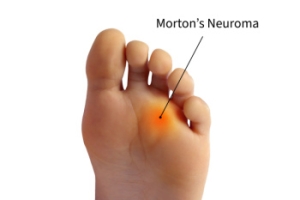 Manging Morton’s Neuroma