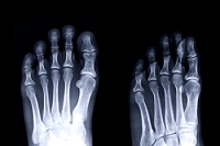 Facts About Stress Fractures