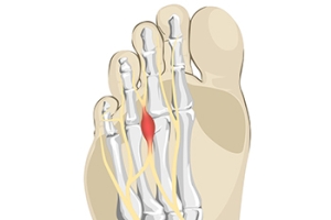 Common Symptoms of Morton’s Neuroma